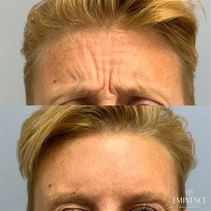 BOTOX® Cosmetic Results Princeton, Montgomery NJ Eminence