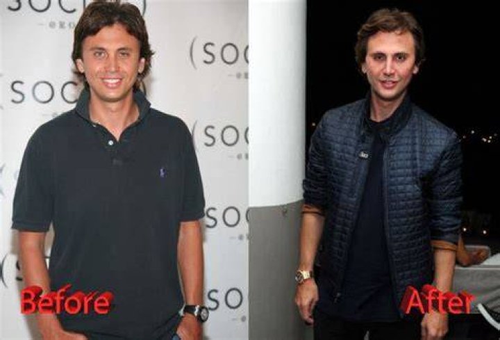 Unveiling Jonathan Cheban's Plastic Surgery Secrets: A Journey Of Transformation